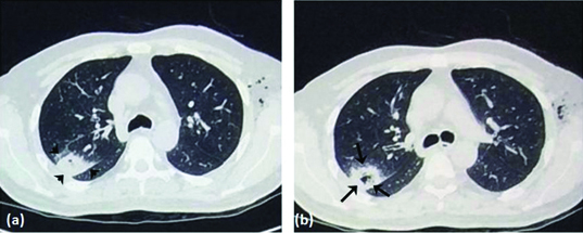 CT scan showing chronological development of halo sign and air crescent sign in invasive aspergillosis
