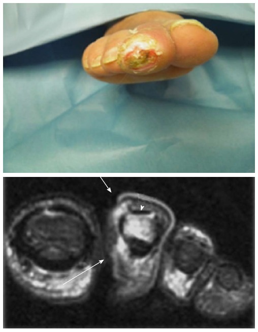 MRI revealing osteomyelitis of the toe distal phalanx in a diabetic foot