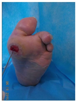 Positive probe-to-bone test demonstrating metal probe reaching bone through diabetic foot ulcer