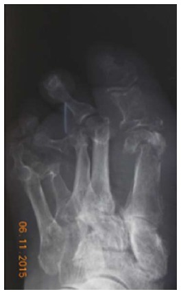 X-ray showing bony destruction of the first metatarsal head from diabetic foot osteomyelitis