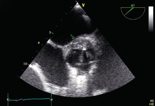 TEE showing echodense posterior aortic abscess as a complication of infective endocarditis