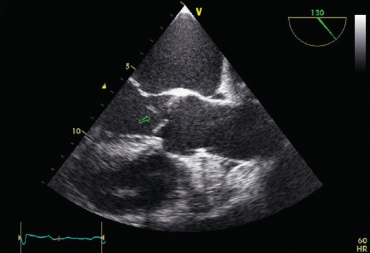 TEE long-axis view showing mobile echogenic vegetation on the aortic valve