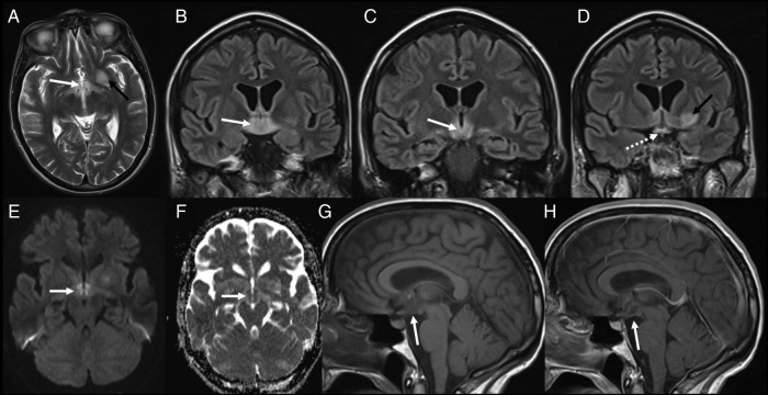 MRI brain findings in HSV encephalitis showing T2 and FLAIR hyperintensity with DWI and ADC maps