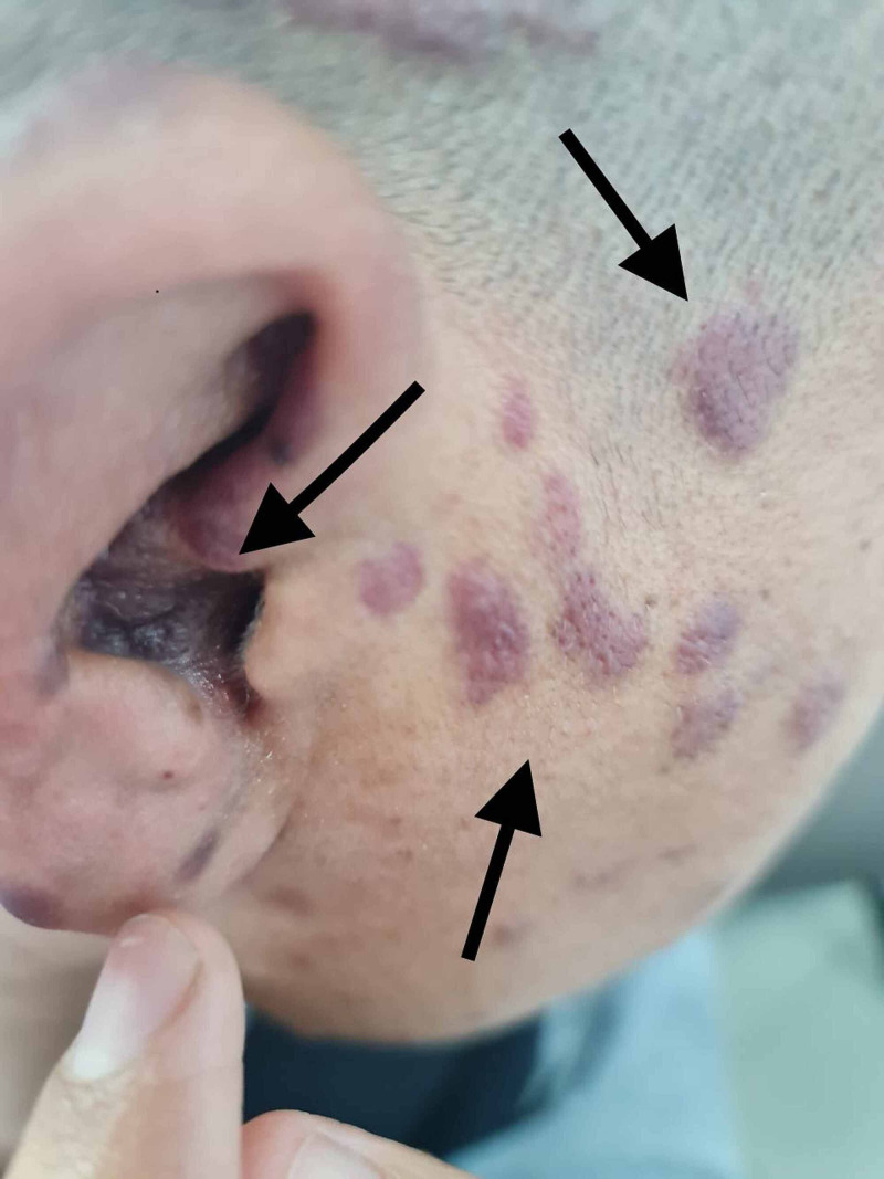 Clinical photograph of Kaposi sarcoma showing violaceous purple plaques on the face and ear