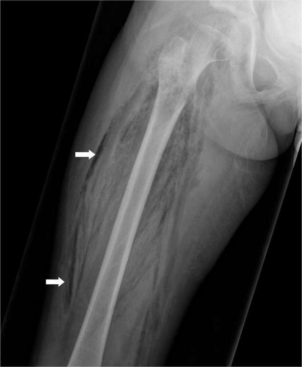 CT scan showing necrotizing fasciitis with extensive soft-tissue gas tracking along fascial planes