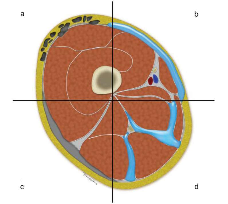 Cross-sectional schematic of the thigh illustrating the spectrum of imaging findings in necrotizing fasciitis