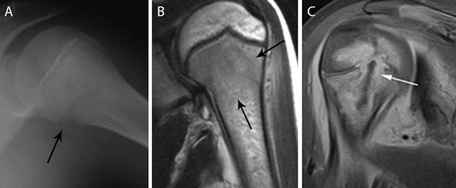 MRI of acute osteomyelitis showing bone marrow edema and periosteal reaction