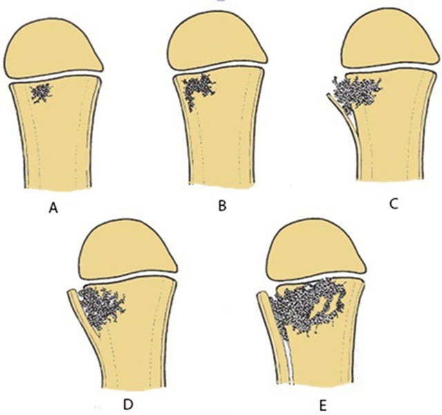 Schematic showing consecutive pathological events in acute osteomyelitis