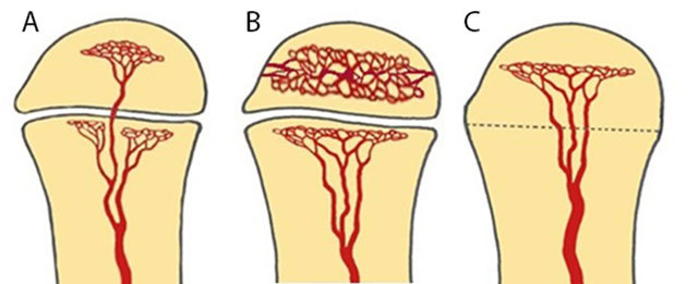 Schematic of vascularization patterns in long bones by age group affecting hematogenous infection spread
