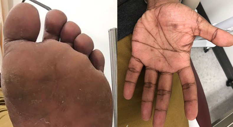 Clinical photograph of secondary syphilis lesions on the palms and soles