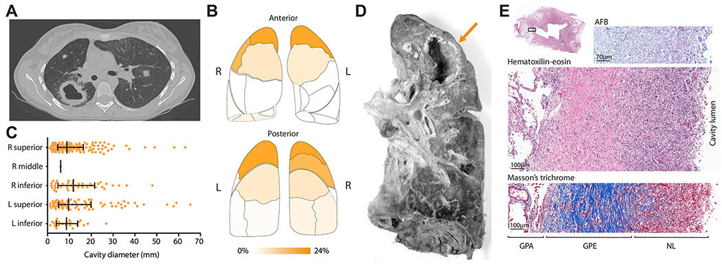 Architecture and anatomy of tuberculosis cavities showing CT reconstruction and histological cross-section