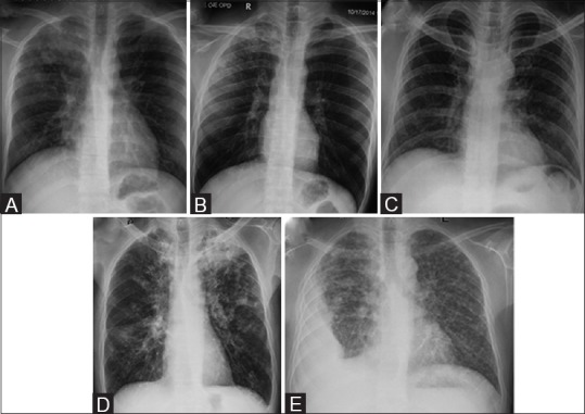 Chest radiograph findings in pulmonary infections showing consolidation patterns