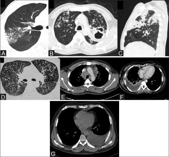 CT chest imaging findings in active pulmonary tuberculosis