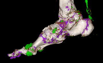 Dual-energy CT imaging showing urate crystal deposits in gout