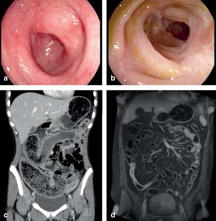 Endoscopic findings comparing Crohn's disease and ulcerative colitis