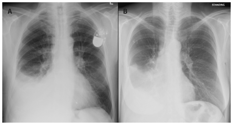 Chest radiographs showing pleural effusion with and without endobronchial obstruction