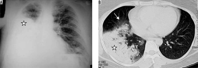Chest radiograph showing lobar pneumonia with air bronchograms
