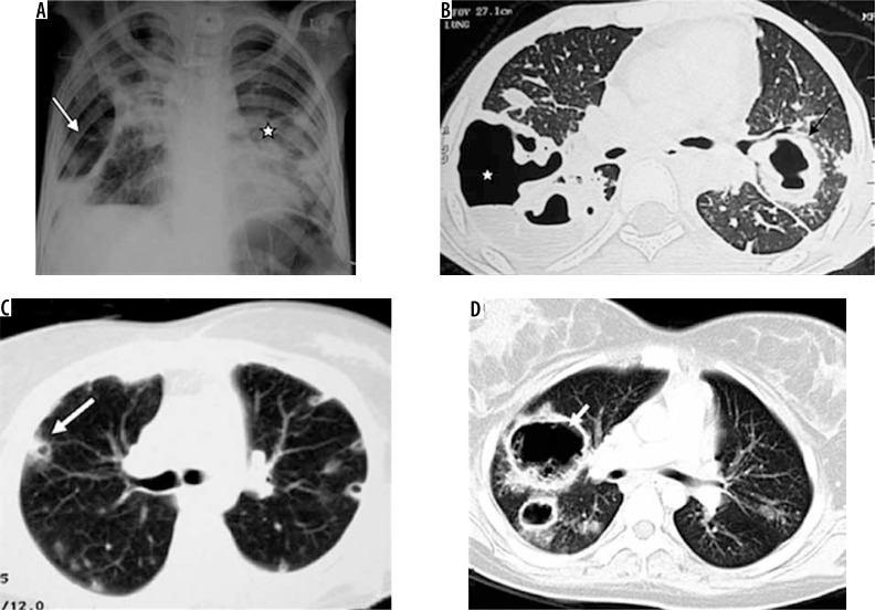 CT imaging patterns of different types of pulmonary infections