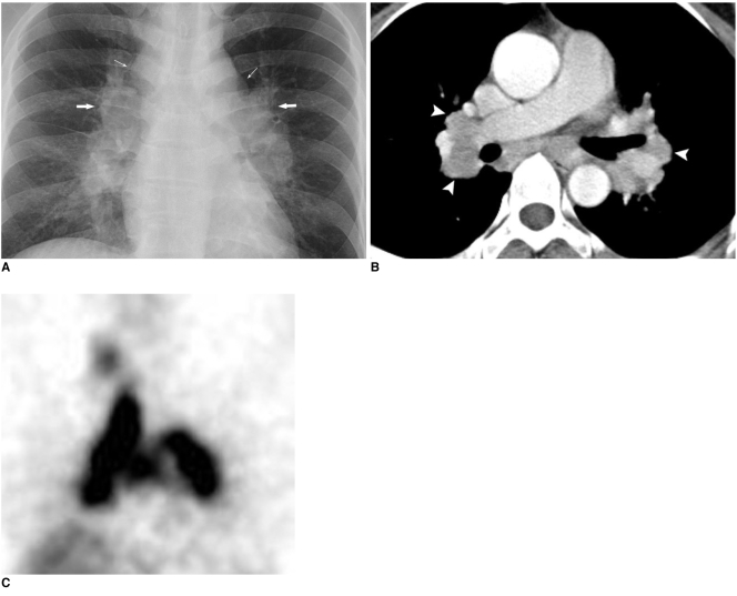 CT scan showing typical and atypical manifestations of intrathoracic sarcoidosis
