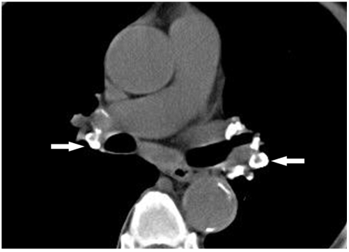 Chest radiograph staging of pulmonary sarcoidosis from Stage I to Stage IV