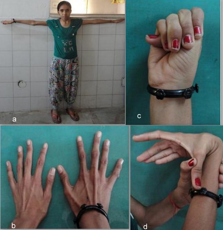 Clinical photograph showing arachnodactyly, dolichostenomelia, and ligamentous laxity in a patient with Marfan syndrome