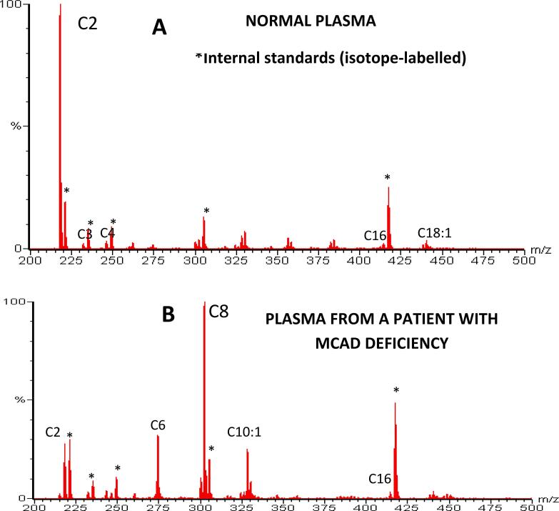 Representative acylcarnitine profiles from tandem mass spectrometry showing normal and abnormal patterns in fatty acid oxidation and organic acid disorders
