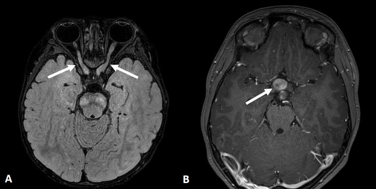 MRI images showing optic pathway glioma in a patient with neurofibromatosis type 1