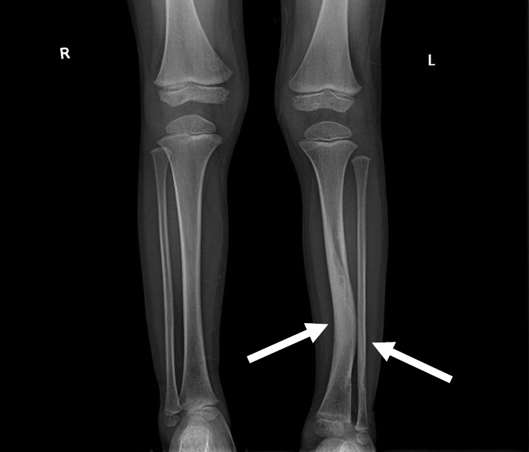 Radiograph showing tibial bowing deformity with pseudarthrosis in a patient with neurofibromatosis type 1