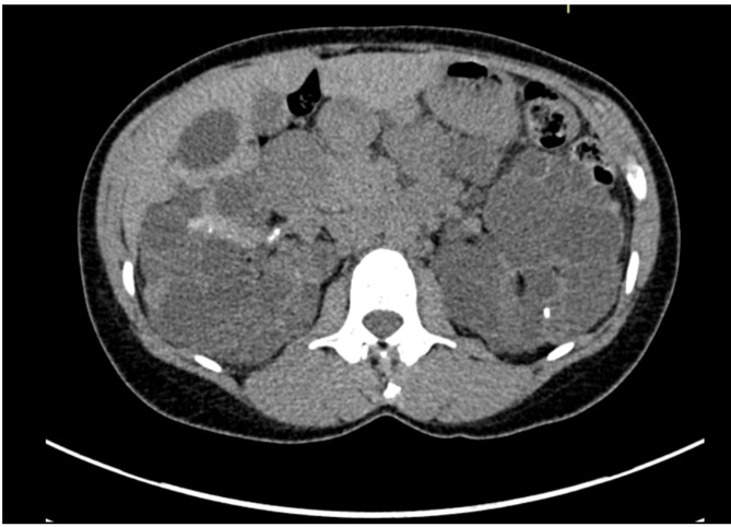 CT scan of polycystic kidney disease showing markedly enlarged kidneys with innumerable cysts
