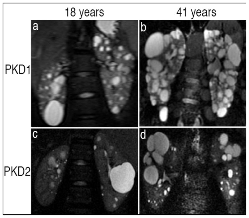 T2-weighted MRI comparing PKD1 and PKD2 kidney phenotypes showing difference in cyst burden