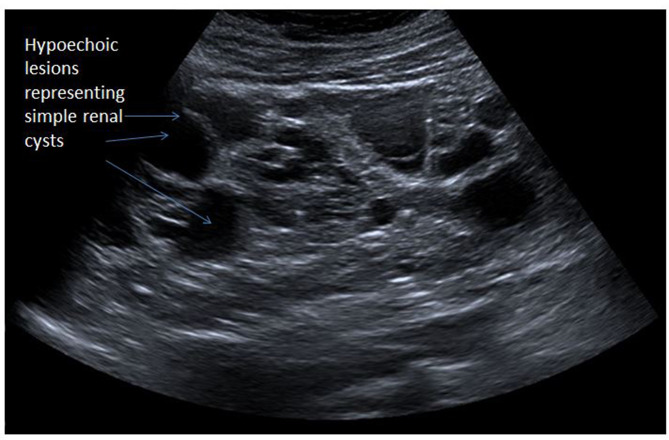Renal sonographic image showing enlarged polycystic kidney with multiple cysts
