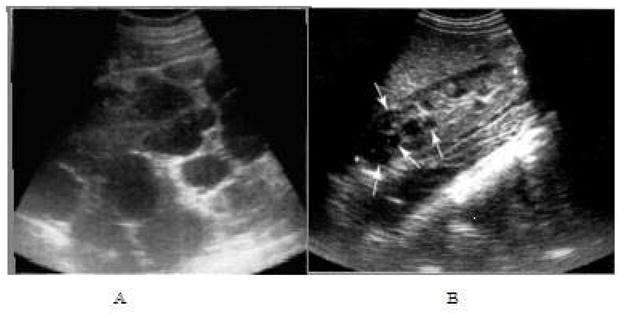 Ultrasound images of autosomal dominant polycystic kidney disease showing bilateral enlarged kidneys with multiple cysts