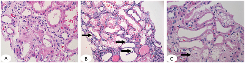 Histopathologic findings in acute kidney injury showing tubular injury patterns