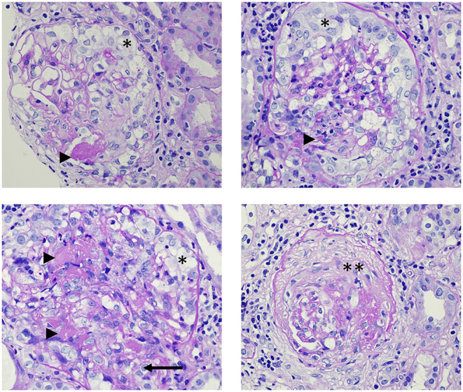 ANCA-associated glomerulonephritis histopathology showing crescentic and necrotizing glomerular lesions