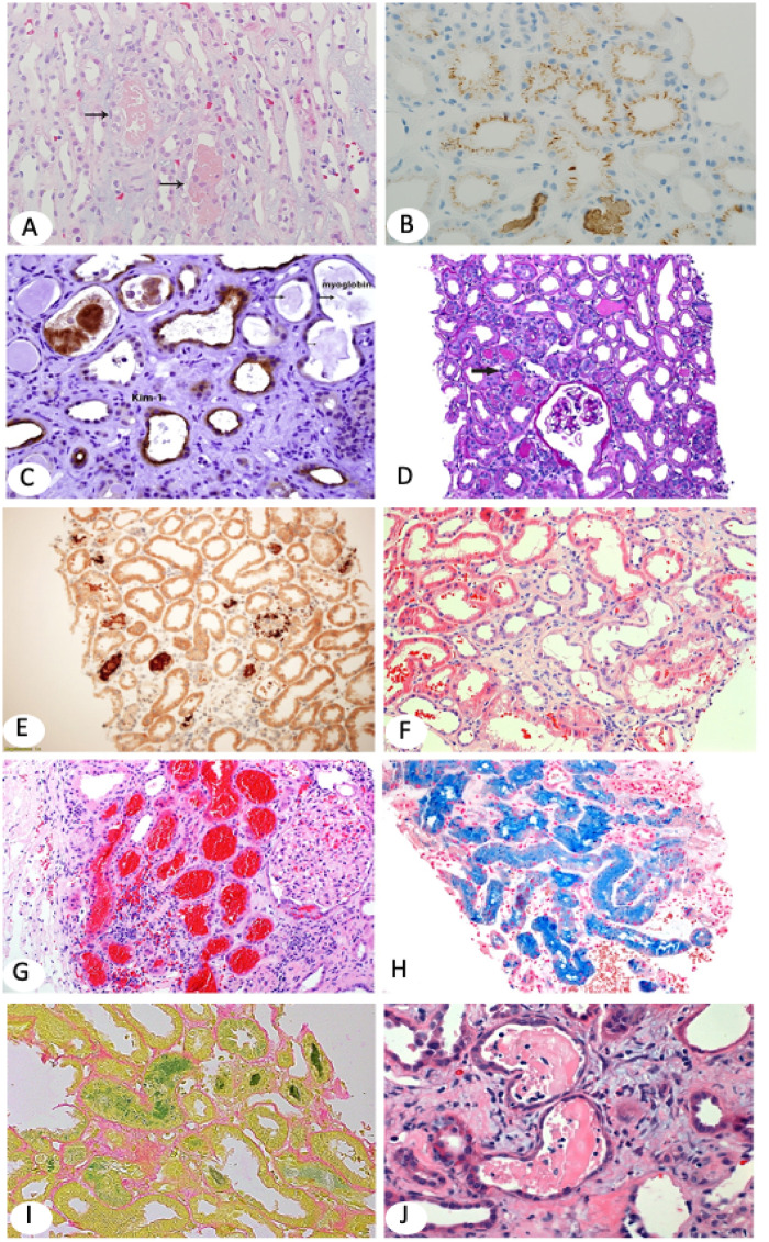 Histology of acute tubular necrosis showing tubular cell injury, muddy brown casts, and myoglobin cast nephropathy