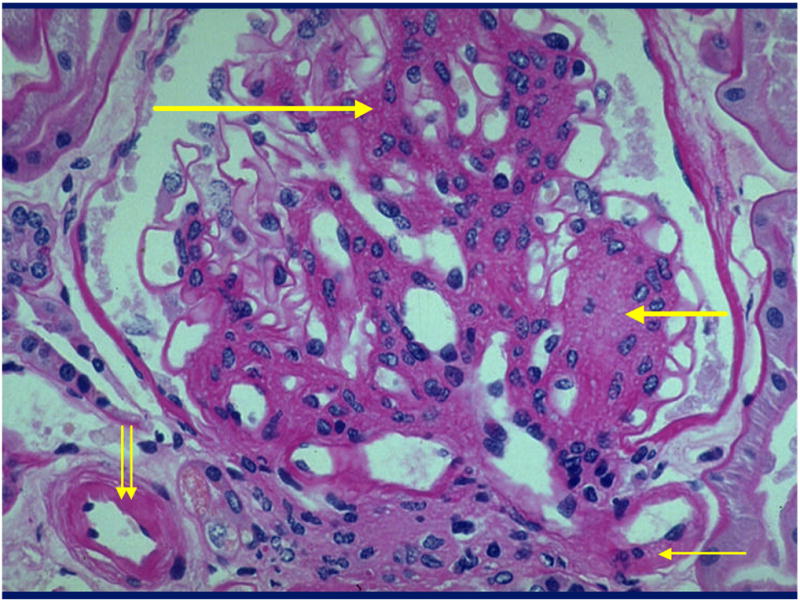 Early diabetic nephropathy histology showing glomerular basement membrane thickening and early mesangial changes