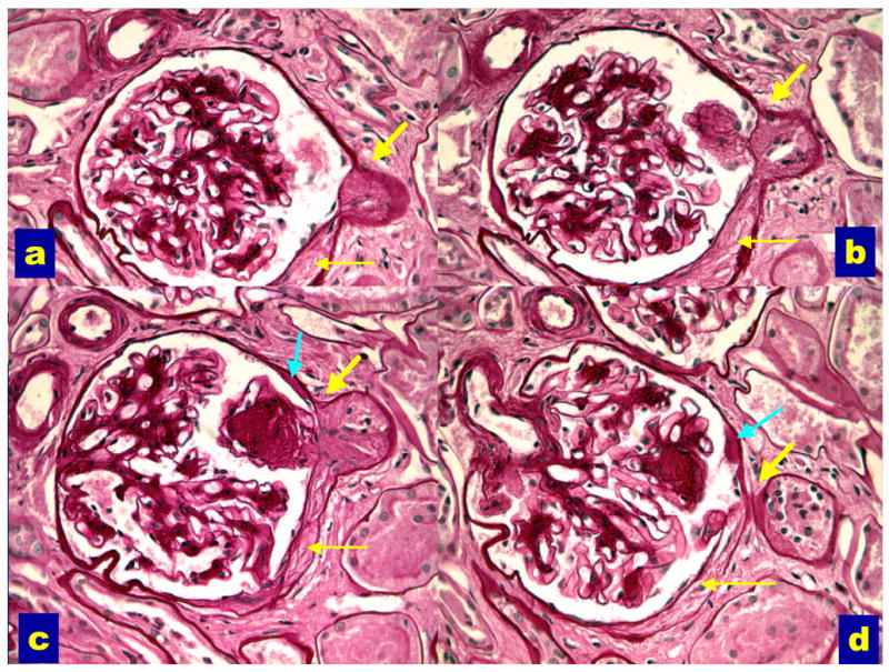Kimmelstiel-Wilson nodules in diabetic nephropathy showing nodular glomerulosclerosis on PAS stain