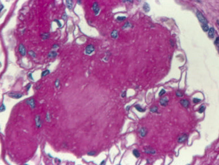 Diabetic nephropathy mesangial expansion and diffuse glomerulosclerosis on histology