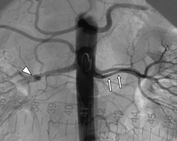 Renal angiography showing classic string of beads appearance of fibromuscular dysplasia in the renal artery