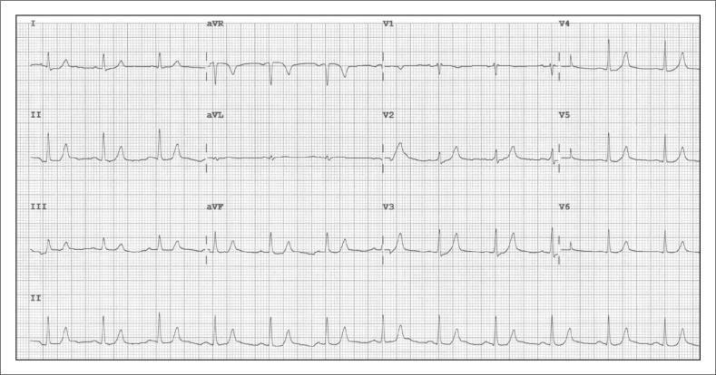 ECG after treatment of hyperkalemia showing resolution of peaked T waves and QRS narrowing