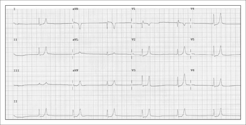 12-lead ECG showing hyperkalemia with peaked T waves, widened QRS, and loss of P waves
