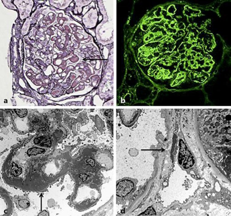 Lupus nephritis renal biopsy showing wire loop lesions, mesangial proliferation, and immune complex deposits