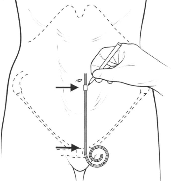 Peritoneal dialysis catheter insertion site selection and anatomical positioning
