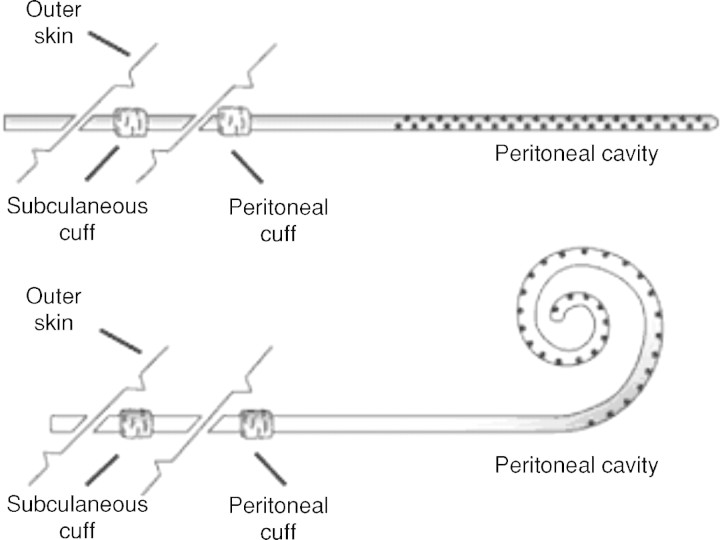 Types of peritoneal dialysis catheters including straight and coiled Tenckhoff catheters with double cuff designs