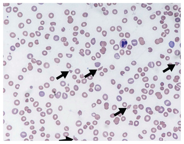 Peripheral blood smear showing schistocytes and fragmented red blood cells characteristic of thrombotic microangiopathy