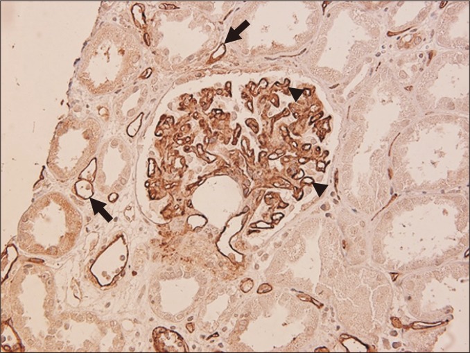 C4d immunohistochemical staining of peritubular capillaries in antibody-mediated rejection