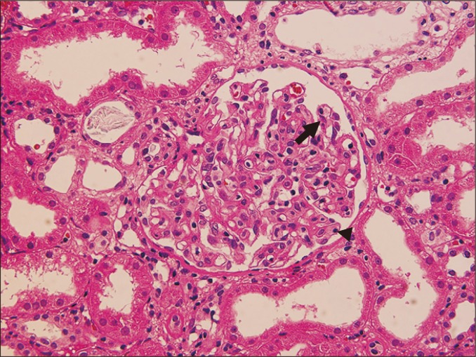 Transplant kidney biopsy showing glomerulitis with endothelial swelling in antibody-mediated rejection