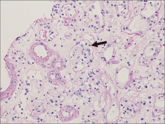 Transplant biopsy showing tubulitis with mononuclear cell infiltration in T-cell mediated rejection