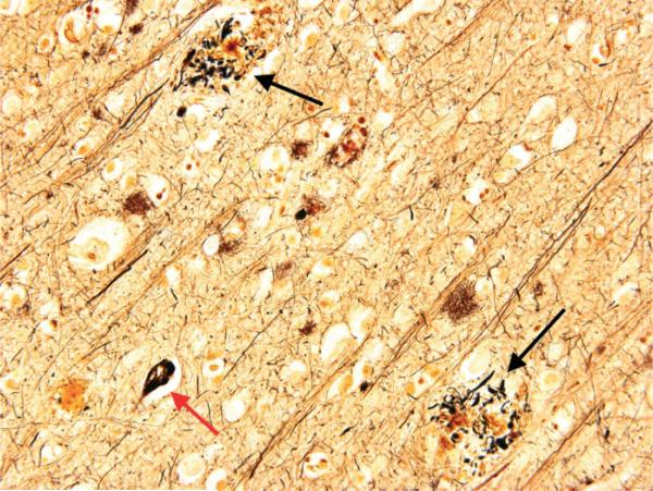 Microscopic image of senile amyloid-beta plaques in Alzheimer disease brain tissue