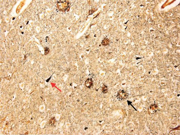 Microscopic image of neurofibrillary tangles in Alzheimer disease brain tissue